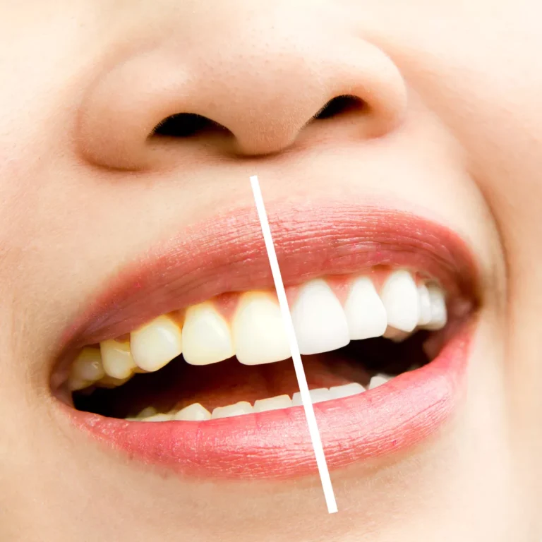 Tratamientos de blanqueamiento dental ambulatorio