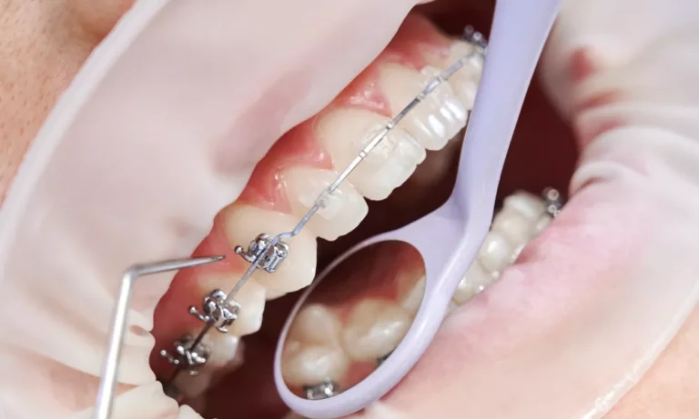 Remineralización para tratamientos de ortodoncia OrthoCare